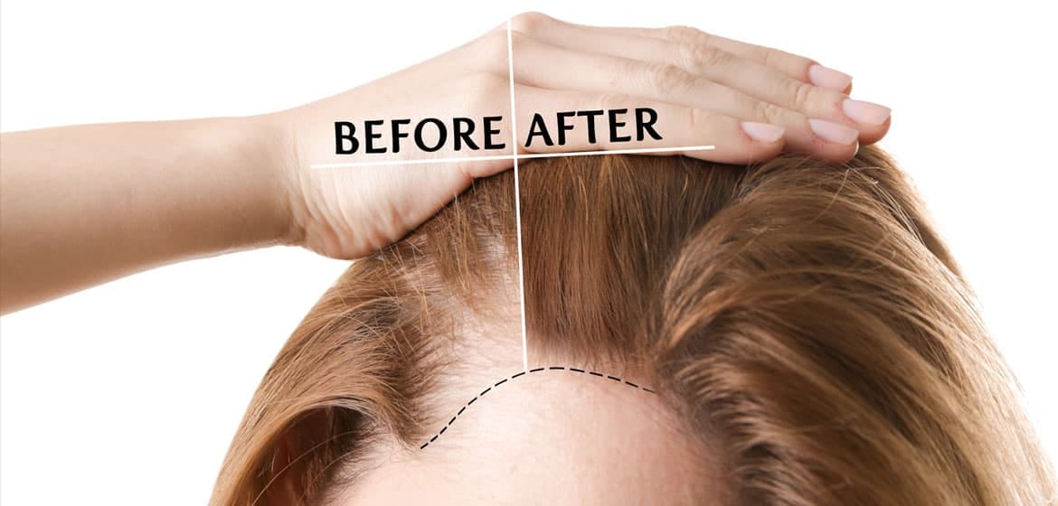 Hair Transplant Turkey: Experience World-Class Medical Tourism