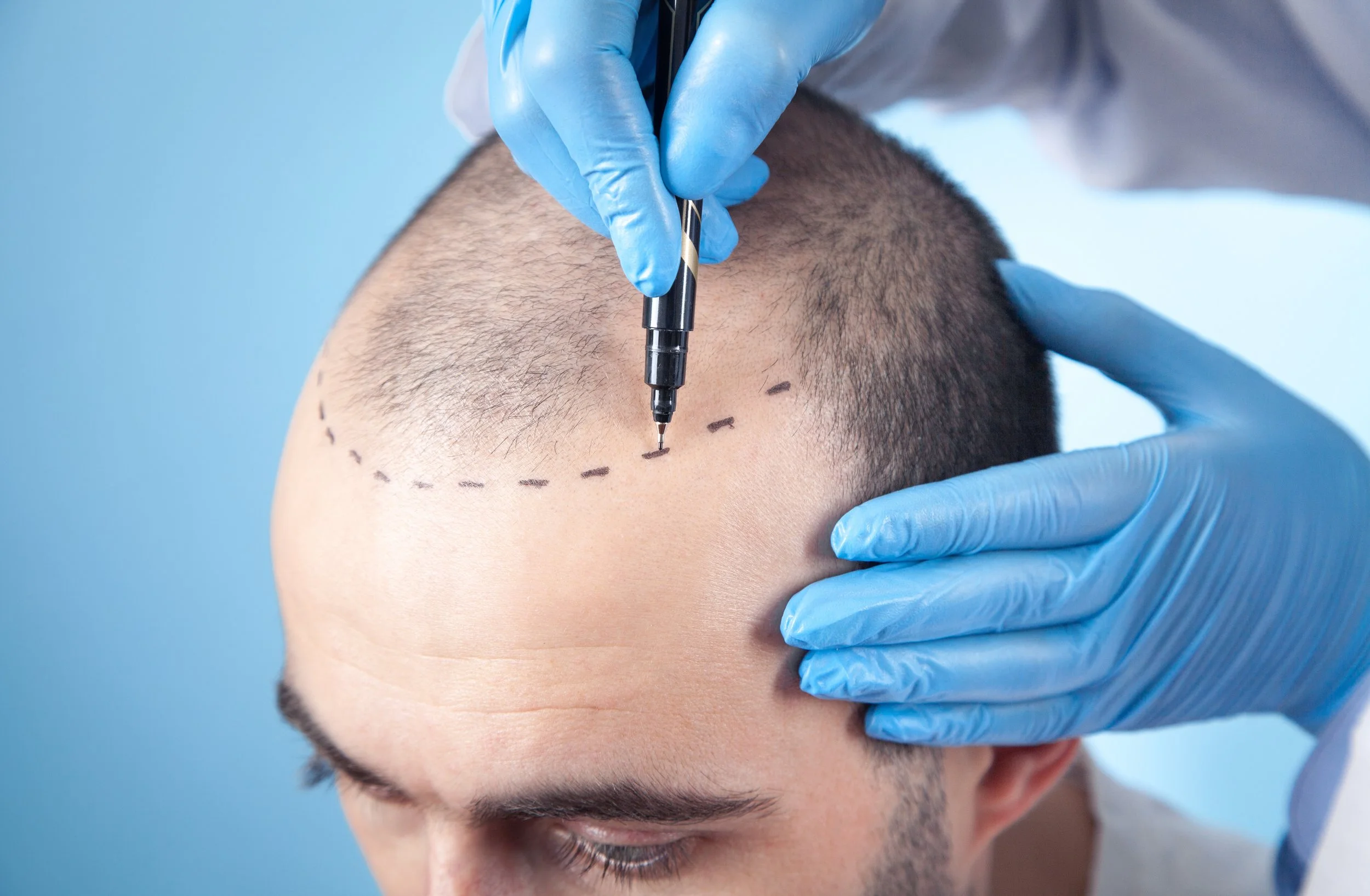 Hair Transplant UK – Discover Natural, Permanent Results