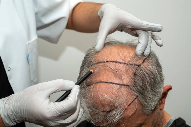 Hair Transplant Price for FUE vs DHI Techniques