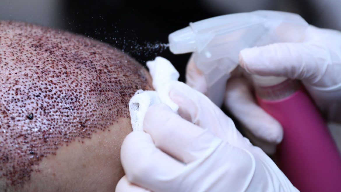 Hair Transplant London – Restore Your Hairline with Confidence